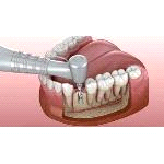 Dental Implants Mexico